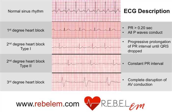 Ecg activity haspi answer key