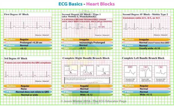 Ecg activity haspi answer key