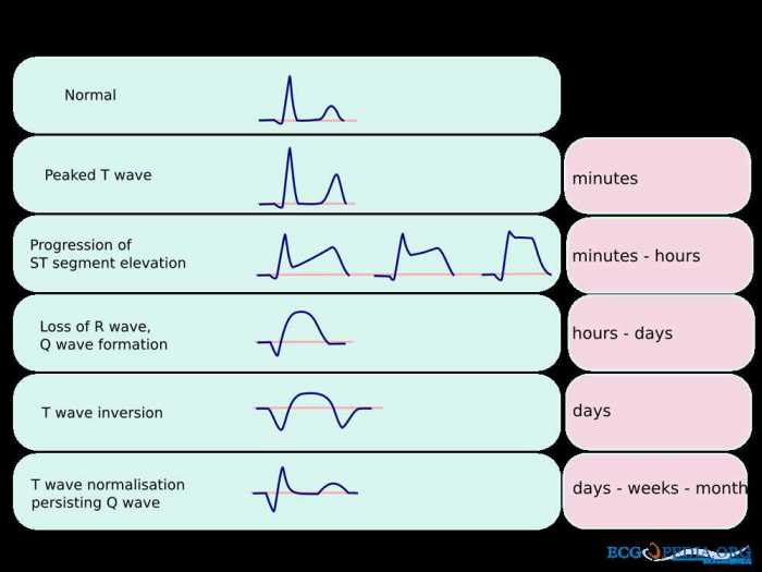 Ecg activity haspi answer key